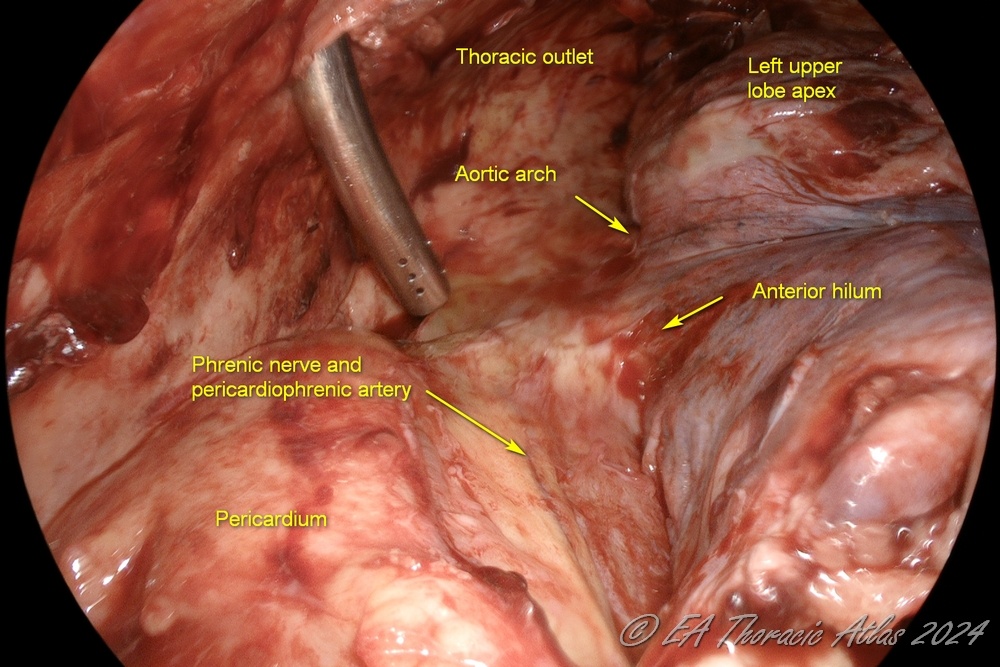 Anterior hilum is completely exposed and cleaned during VATS empyema drainage and decortication