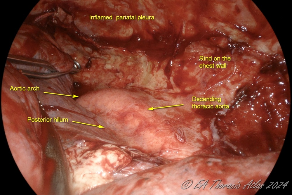 Posterior mediastinum is exposed and cleaned during VATS complicated effusion or empyema drainage and decortication