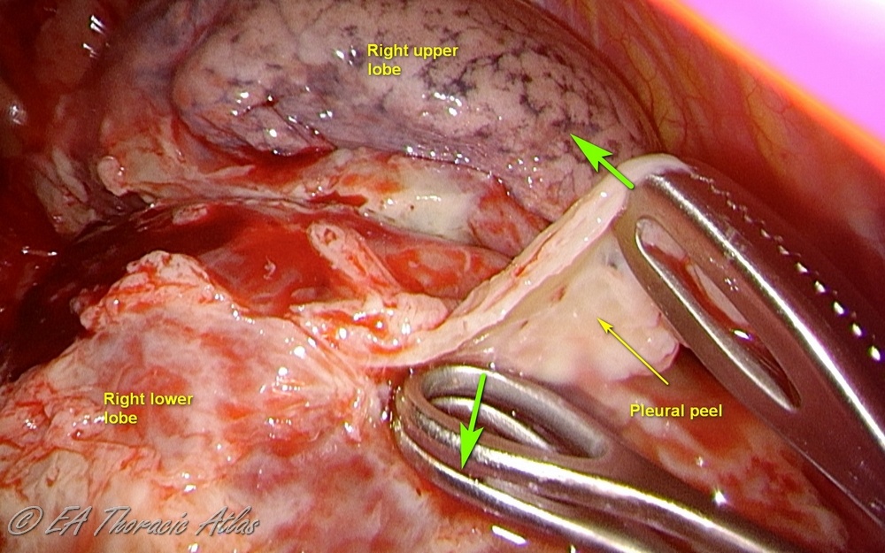 Loosely adherent rind can be removed during thoracoscopic decortication using clamps ( optimal direction of retraction is marked with green arrows )
