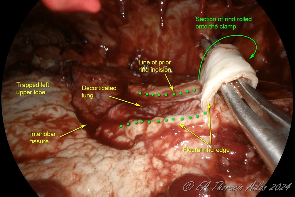 “Rolling” maneuver over the clamp may be used during  decortication