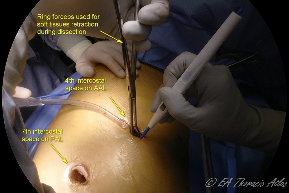 Skin incisions for thoracoscopic VATS empyema drainage and decortication