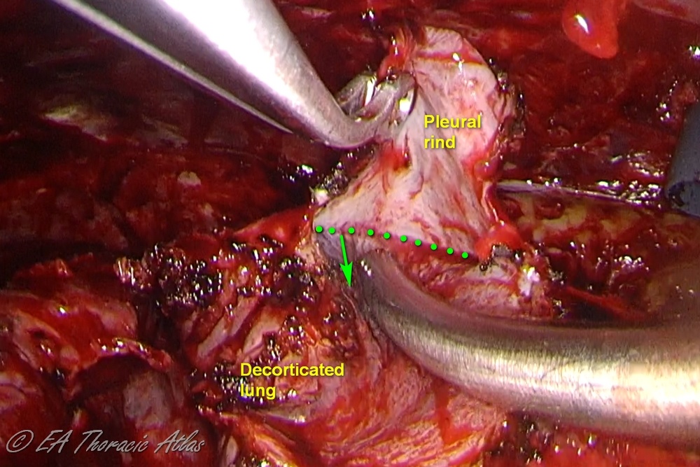 VATS decortication. Note the small amplitude of movement of the suction (green arrow) very close to the rind lung interface (dotted green line)
