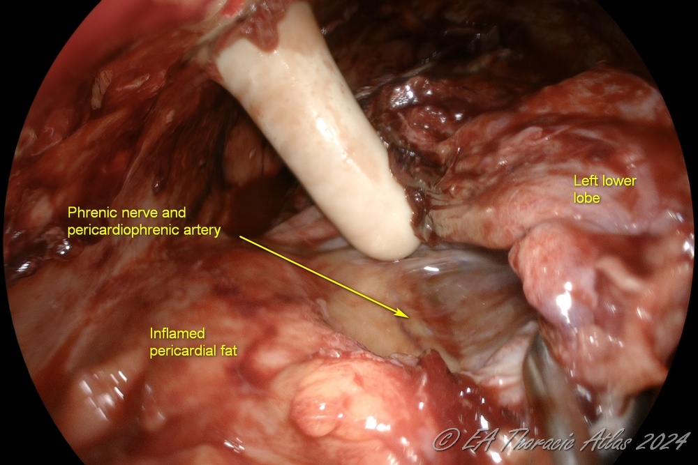 Finger dissection may facilitate mobilization of adhesions during  VATS empyema drainage and decortication