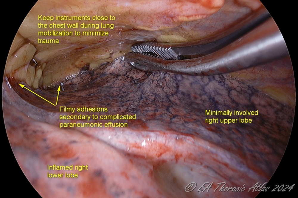 Lung is gently mobilized off the chest wall during empyema or complicated parapneumonic effusion VATS drainage 