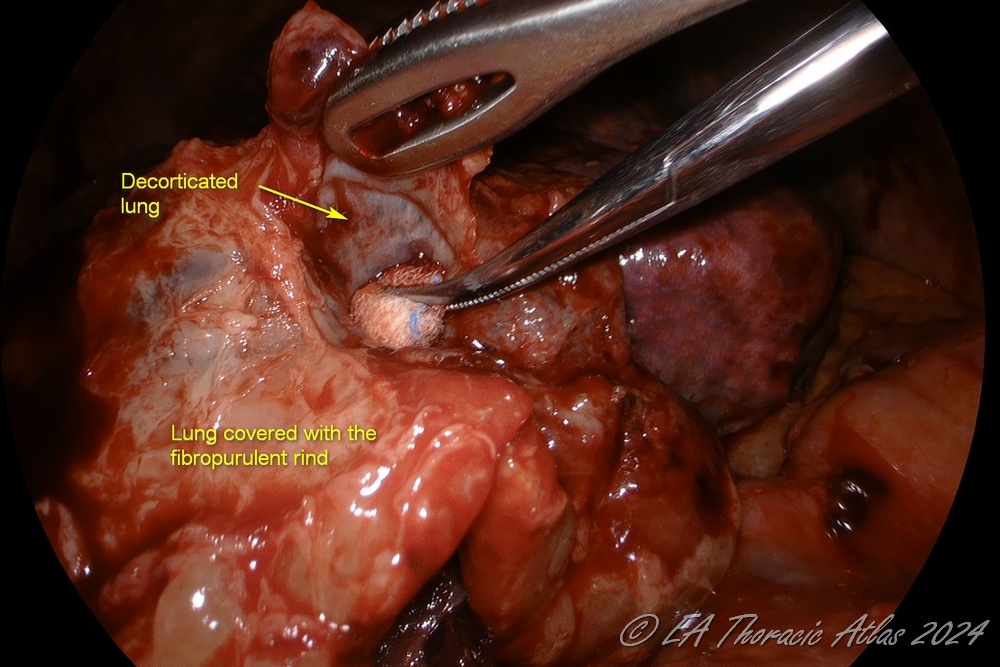 “Peanut” dissection can be used during  lung decoration