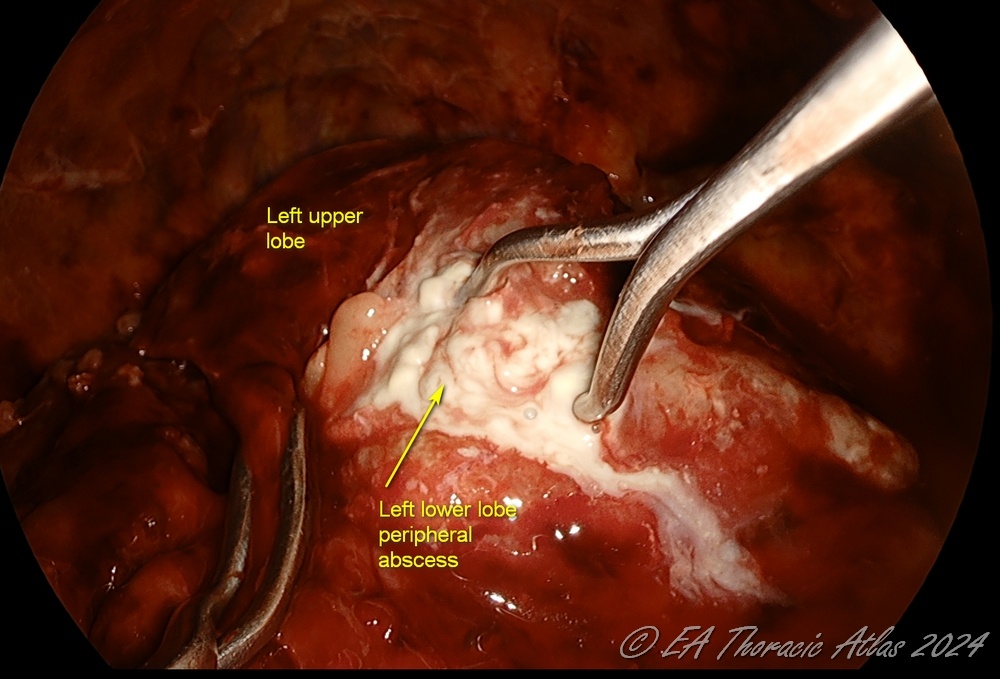 Peripheral subpleural abscesses that are encountered (should be carefully unroofed and drained during thoracoscopic (VATS) empyema drainage and decortication