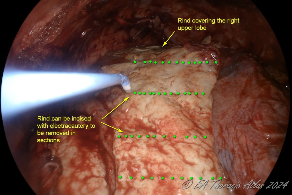 Large areas of ring can be incised with electrocautery to be removed in sections during thoracoscopic (VATS) empyema drainage and decortication