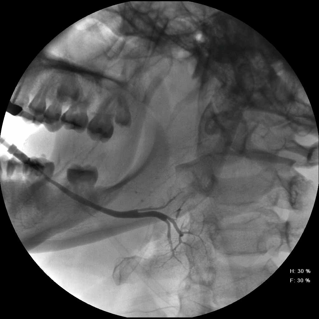 Normal Submandibular Sialogram Sequence | Iowa Head and Neck Protocols ...