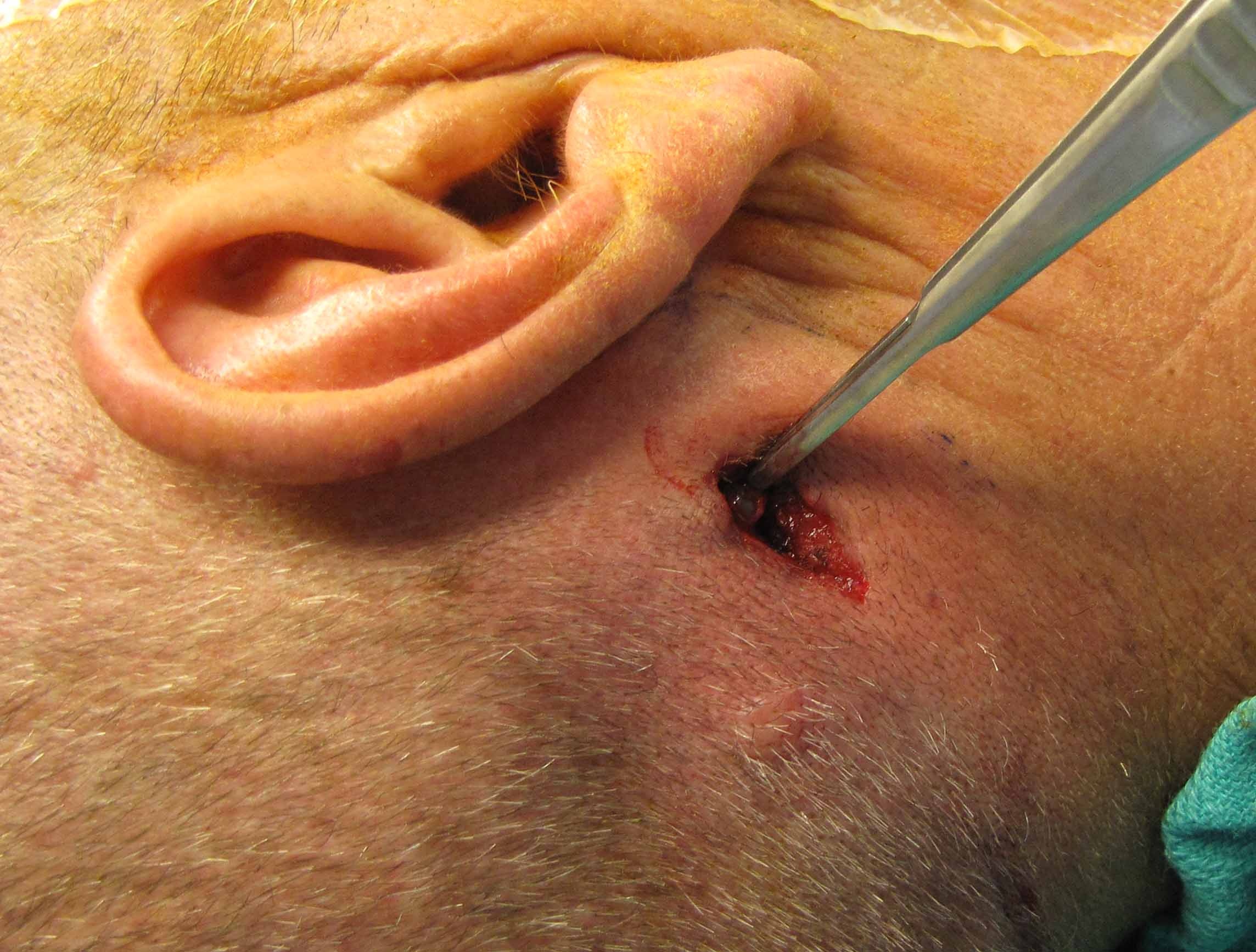 Sentinel Lymph Node Biopsy - Case example | Iowa Head and Neck ...