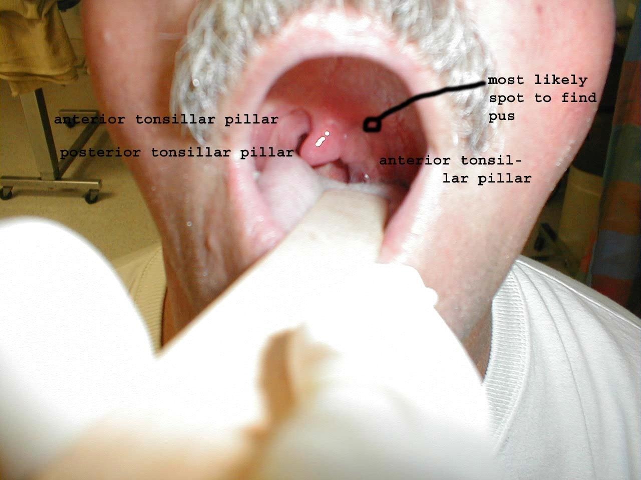 peritonsillar-abscess-pta-management-iowa-head-and-neck-protocols