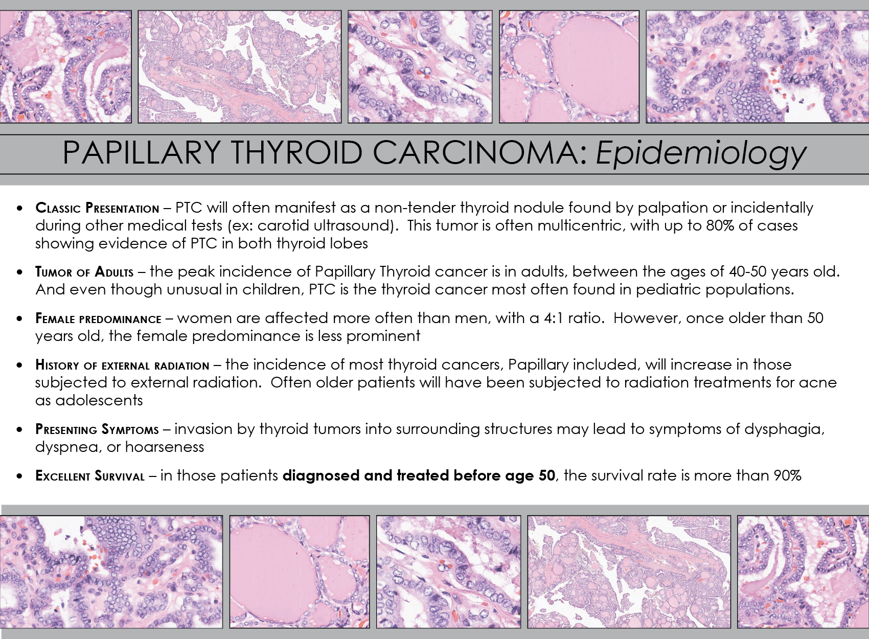 Papillary Thyroid Carcinoma | Iowa Head and Neck Protocols - Carver ...