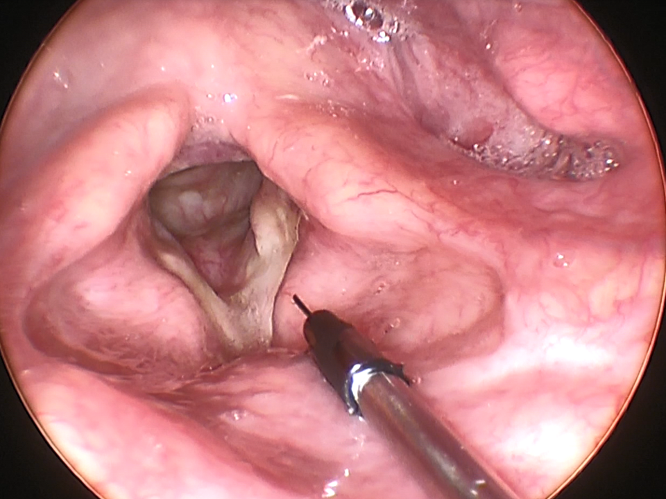 Vocal Cord Injection with Prolaryn Gel with Videostroboscopy (Transoral ...