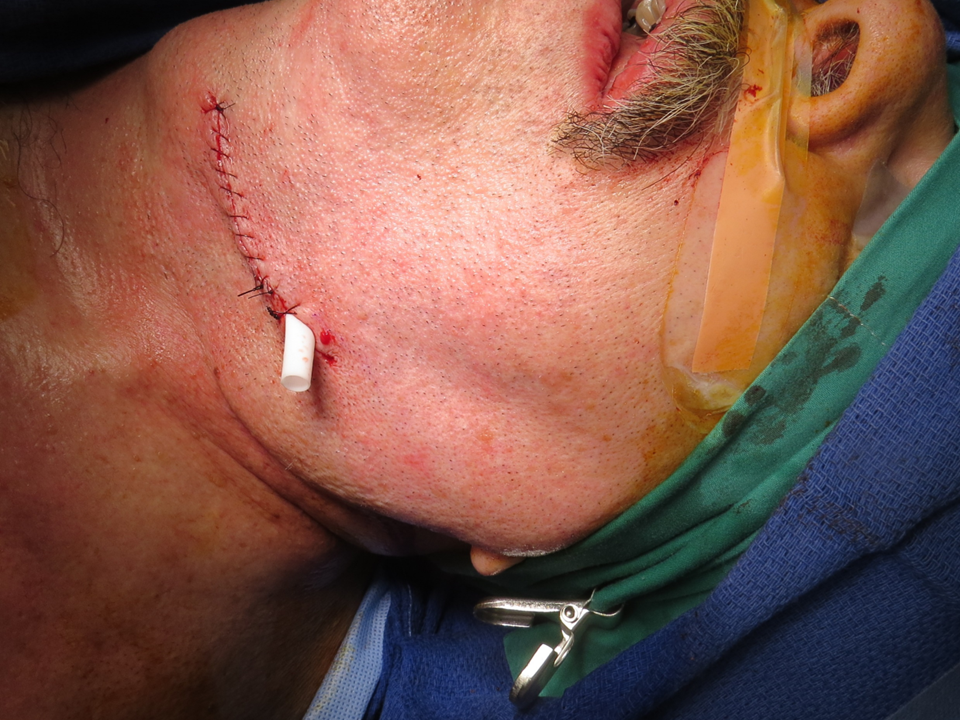 Submandibular Gland Resection/Excision | Iowa Head and Neck Protocols ...