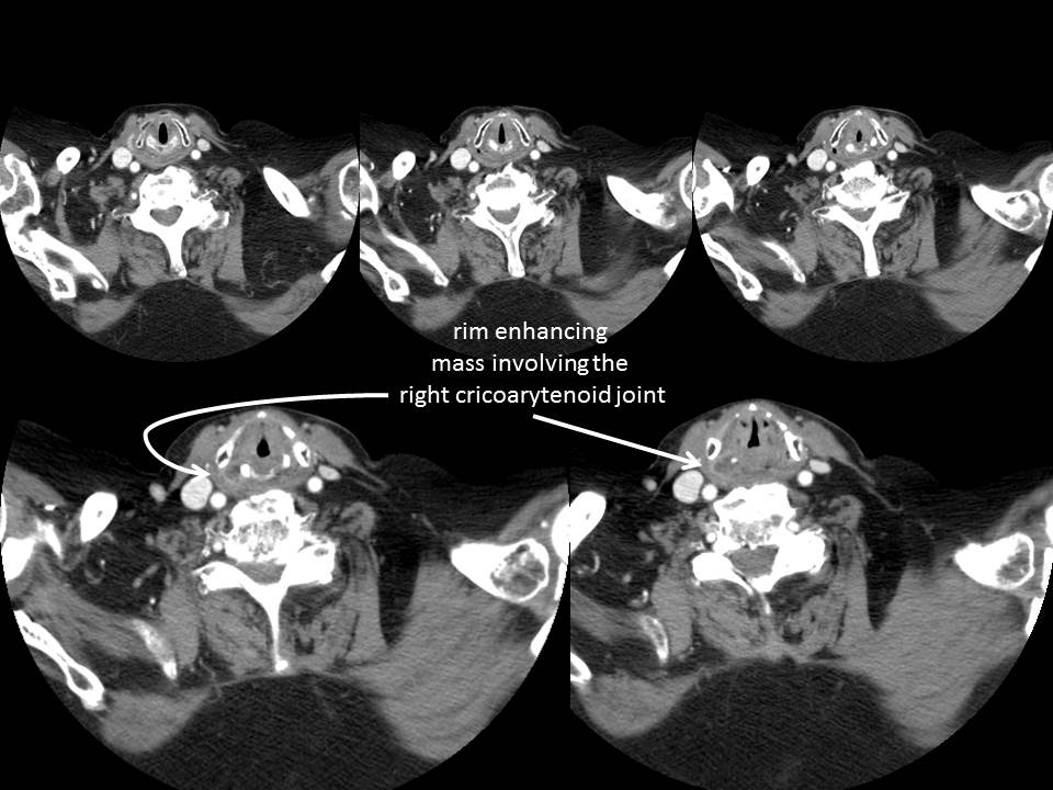Cricoarytenoid Abscess with Rheumatoid Arthritis - Clinical Case ...