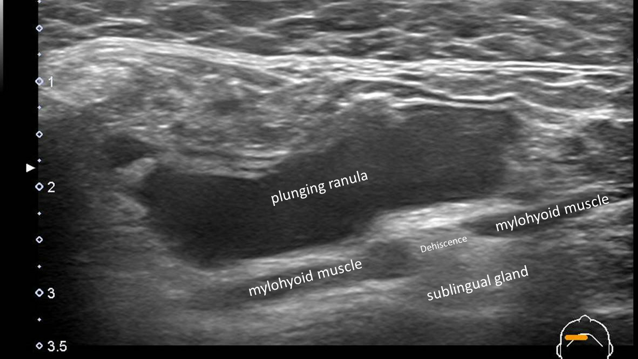 Submandibular Gland Anatomy: The Uncinate Process of the Deep Lobe ...