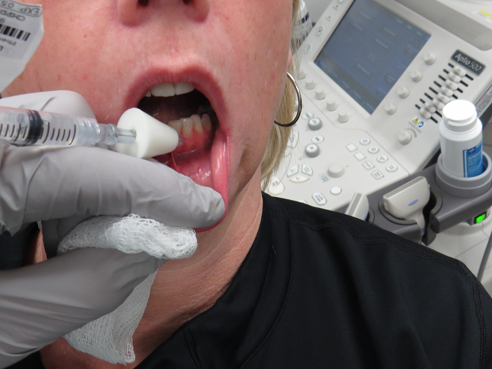 Lip Biopsy for Sjogren's Syndrome (Minor Salivary Gland Biopsy) Using ...
