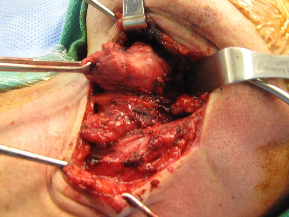 Level I Neck Dissection - Pleomorphic Adenoma of Submandibular Gland ...