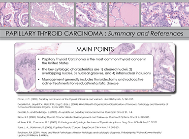 Papillary Thyroid Carcinoma | Iowa Head and Neck Protocols - Carver ...