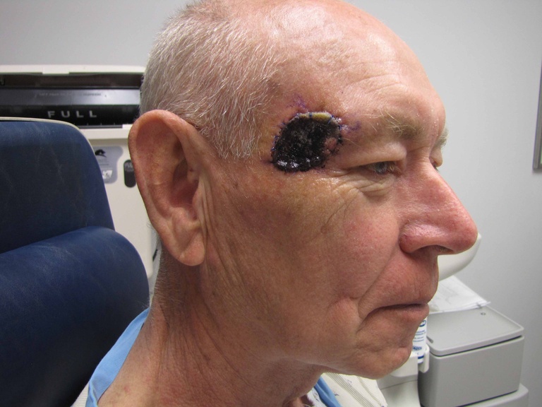 Telfa bolster over porcine graft (post-op day #4); ready for FTSG