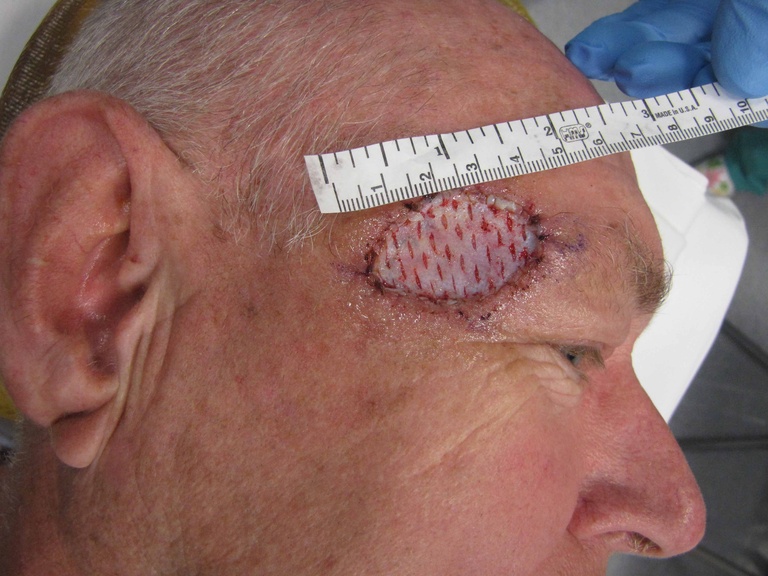 Porcine xenograft in place; ready for removal and replacement with FTSG