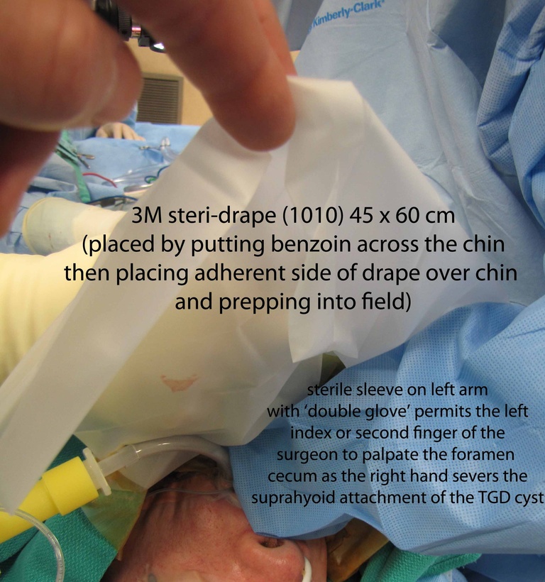 0019%20palpate%20foramen%20cecum.jpg