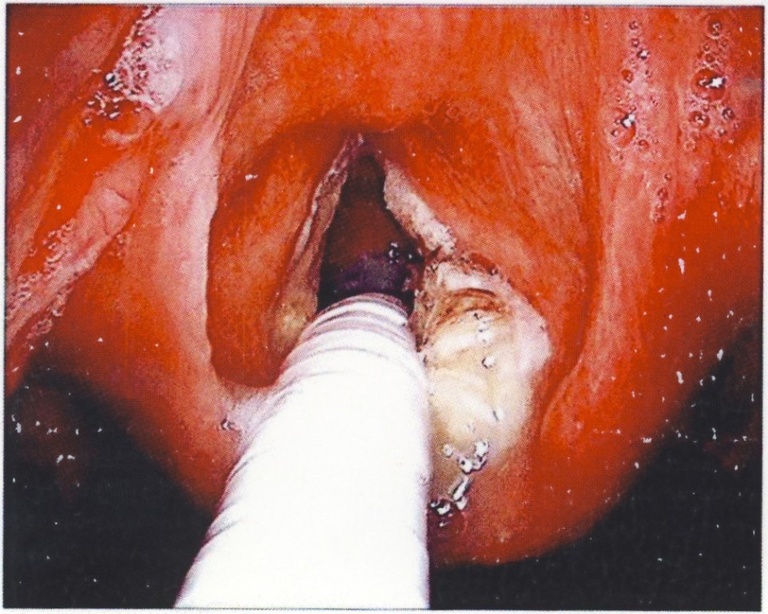 Gross inspection of the vocal cords shows an exophytic, friable white lesion on the right true vocal cord