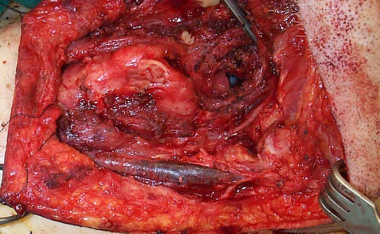 Labelled surgical site. Note commmunication to oropharynx exposing epiglottis and endotracheal tube