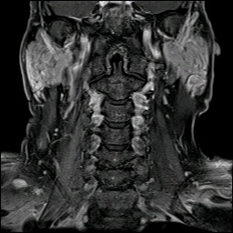 002%20mri%20tail%20parotid.jpg