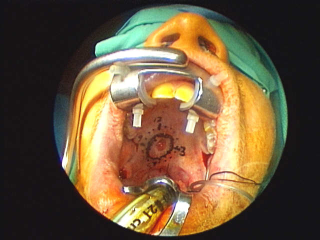 Crowe-Davis retractor in place