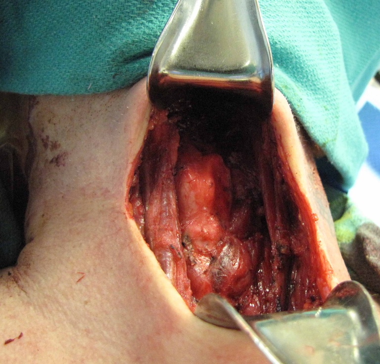 0021%20after%20resection.jpg