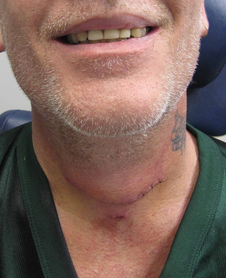 0024%20drain%20and%20sutures%20removed%20one%20week%20postop.jpg