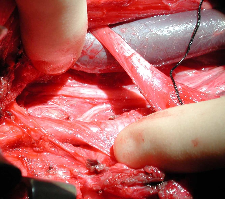 View of both vagus and nonrecurrent nerve. Chest to left, chin to right. Fingers are distracting the IJV and carotid artery underlying omohyoid muscle