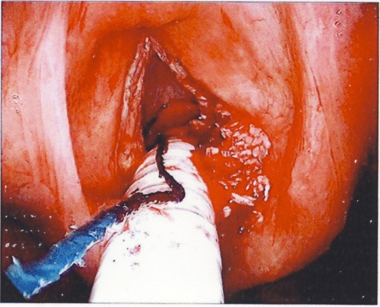 During the process of removal, white flakes of friable material litter the area. This material correlates with the extensive hyperkeratosis seen in verrucous carcinoma.