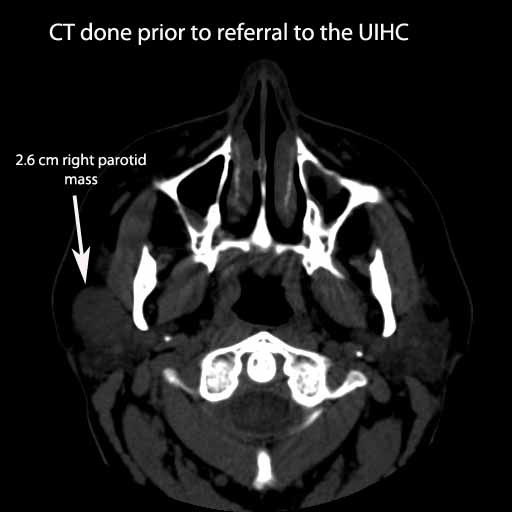 003%20a%20CT%20buccal%20branch%20resected%20.jpg