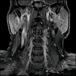003%20mri%20tail%20parotid.jpg
