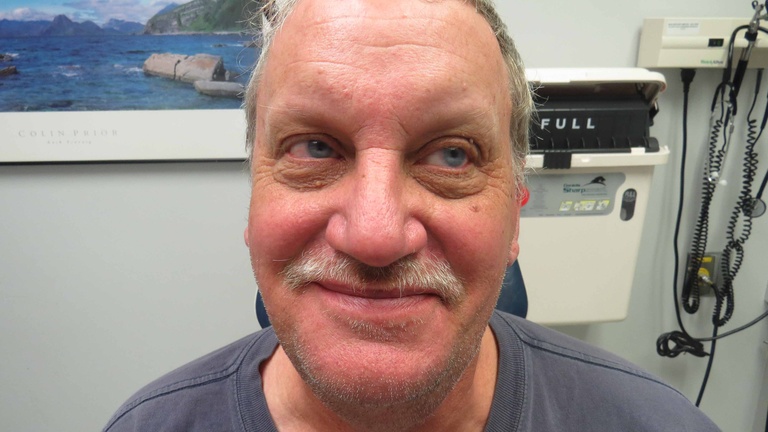 4 1/2 months after parotidectomy