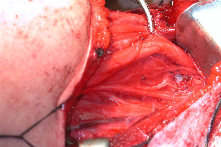 Orientations changed: chin to left, chest to right. Note node with papillary thryoid cancer under carotid artery adjacent nonrecurrent nerve.