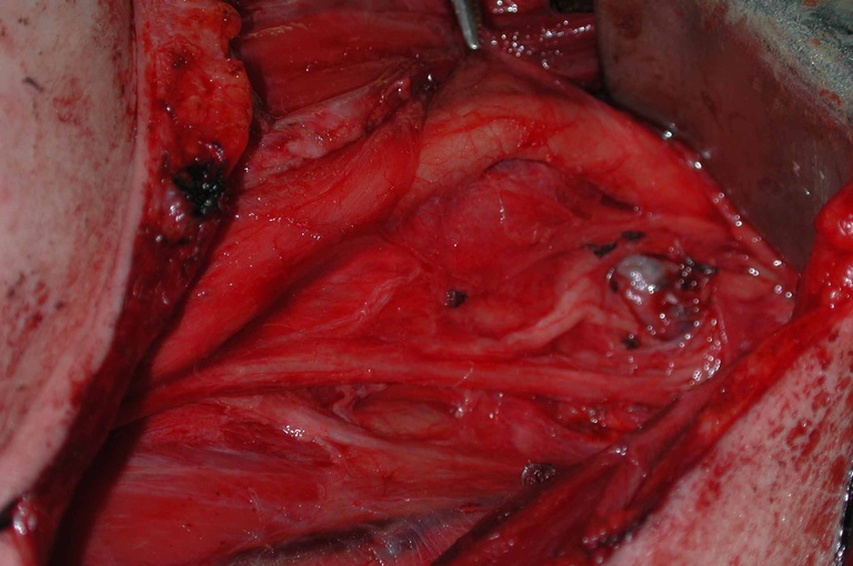 View of nonrecurrent nerve coming off vagus. Chin to left, chest to right