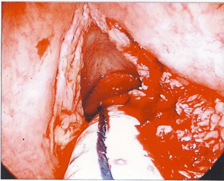 Abundant keratotic debris is evident.