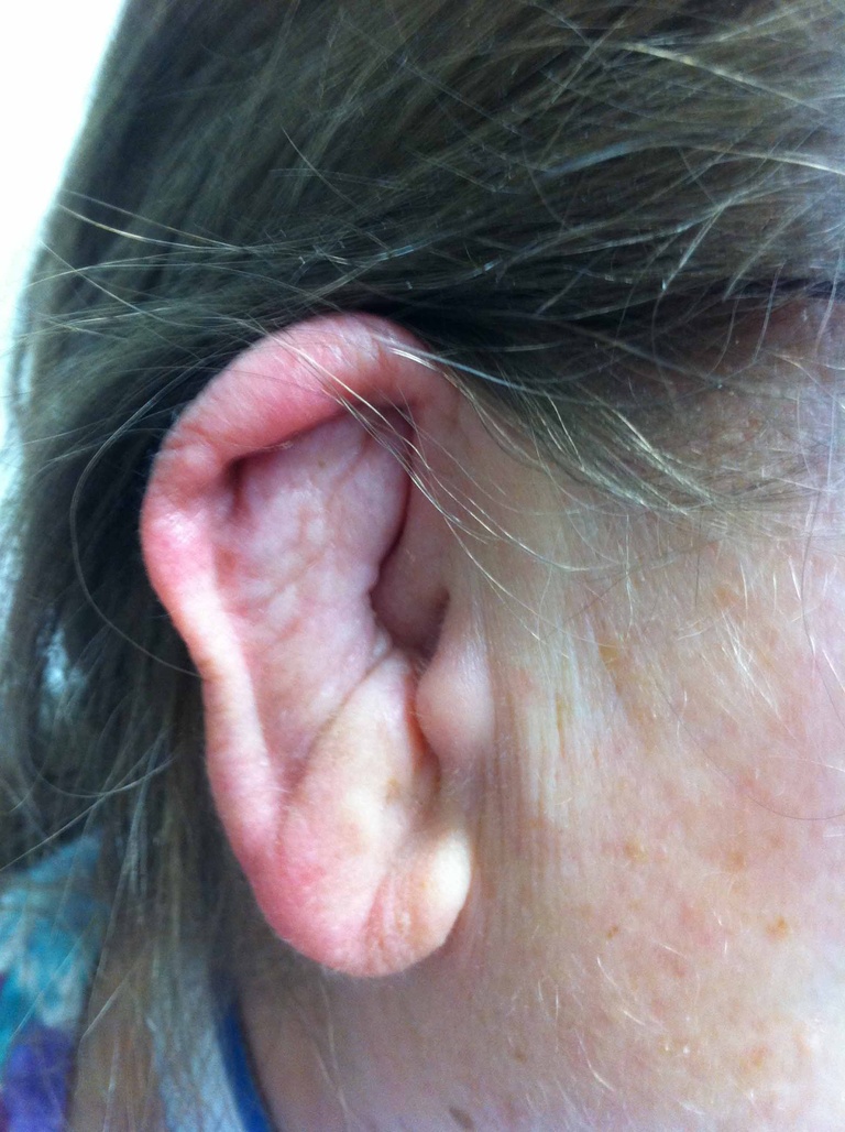 10-21-10 auricular changes improved after 6 weeks of prednisone and cell cept