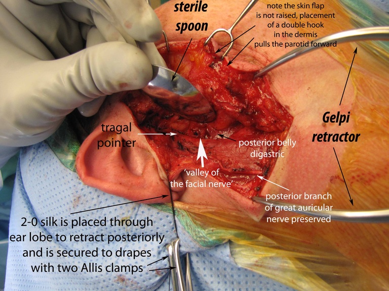 004%20a%20buccal%20br%20resected%20072011.jpg