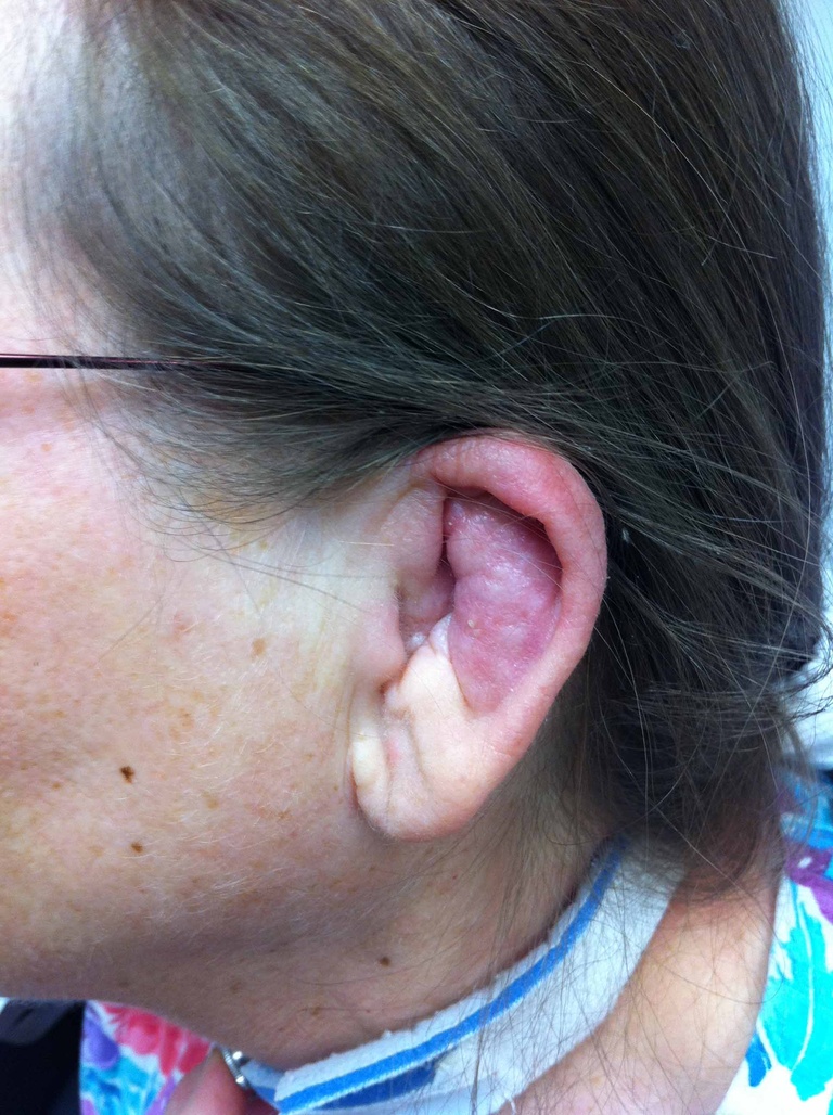 10-21-10 note involvment of cartilaginous auricle sparing the earlobe