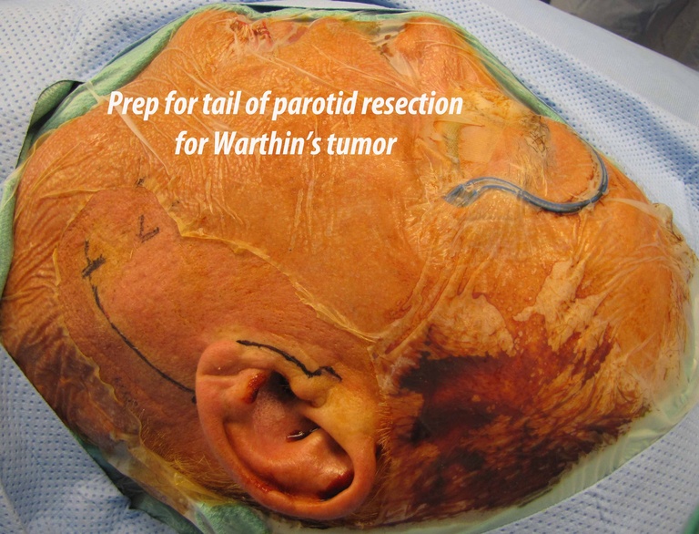 005%20a%20warthins%20resection.jpg
