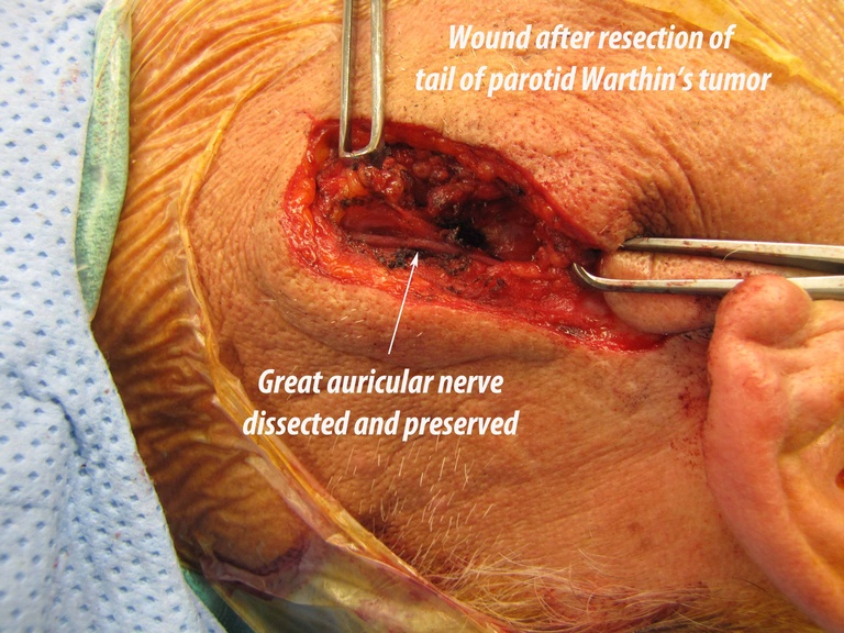 005%20b%20warthins%20resection.jpg