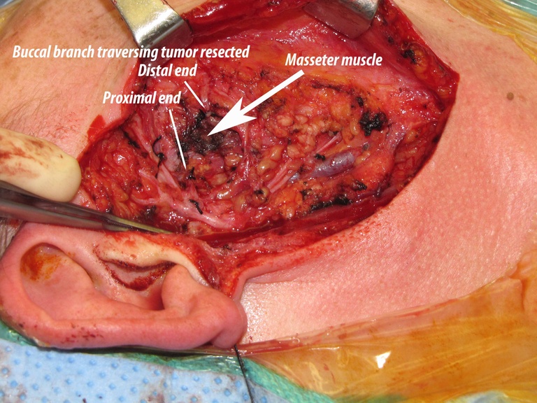 005%20buccal%20br%20resected%20072011.jpg