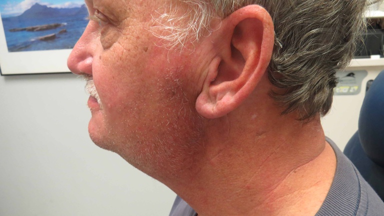 4 1/2 months after parotidectomy
