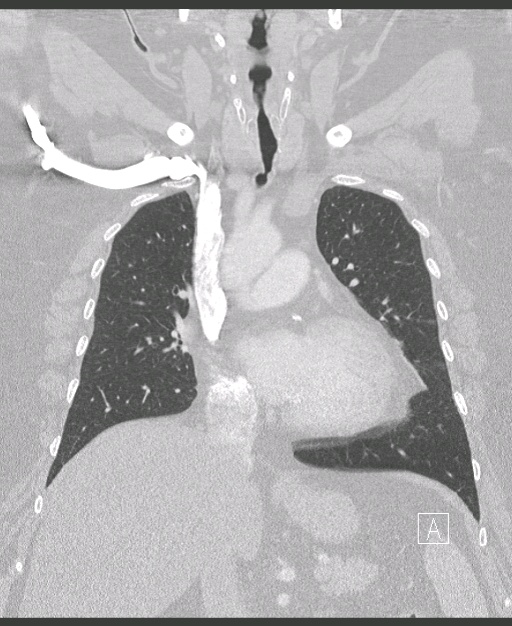 005%20trachstenosis.jpg