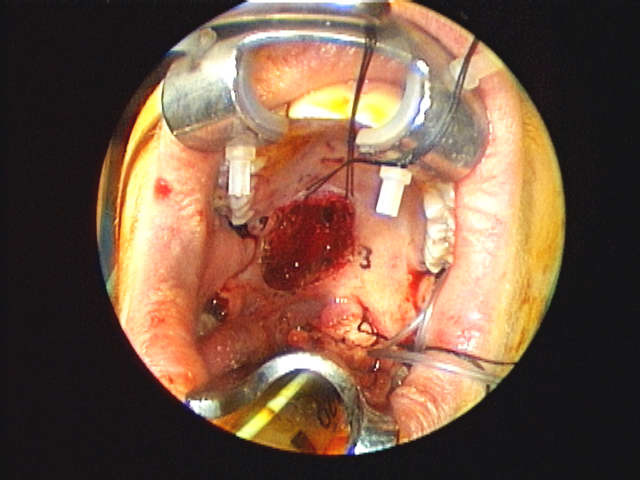 defect from resection