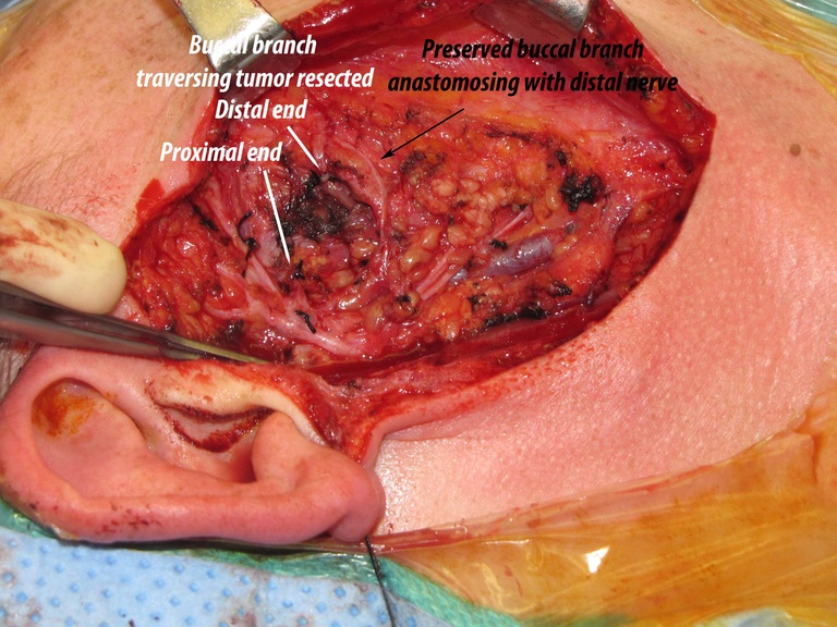 006%20buccal%20br%20resected%20072011.jpg