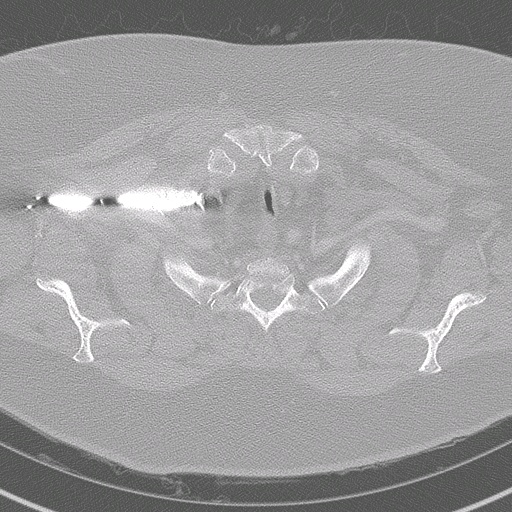 006%20trachstenosis.jpg